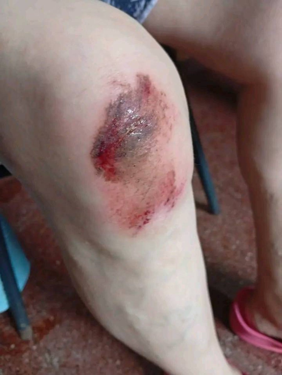 La rodilla derecha de la damnificada.