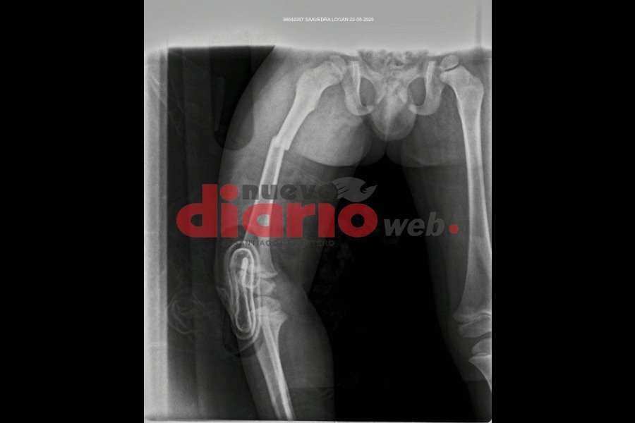 <b>La radiograf&iacute;a al menor de edad.</b>