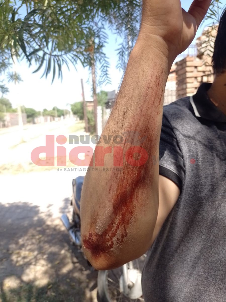 <b>El due&ntilde;o de casa, con su brazo lastimado por la ca&iacute;da.</b>
