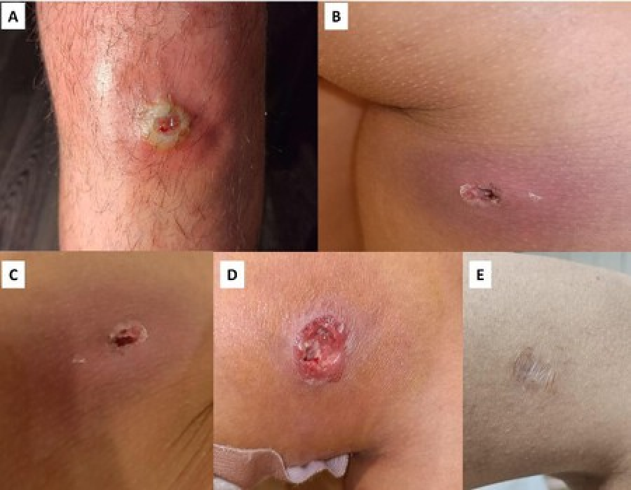 <i>Detalle de la lesi&oacute;n cut&aacute;nea en fase de descamaci&oacute;n del var&oacute;n con mordedura presuntamente de Loxosceles rufescens a la altura de la rodilla. Imagen: Desinsectador</i>